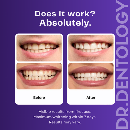 Purple Teeth Whitening Strips